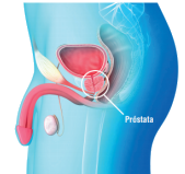 Ilustracao Câncer de Prostata